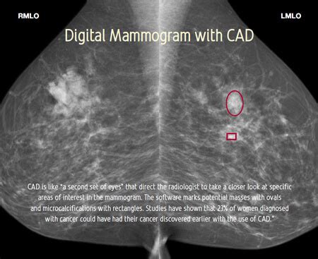 the villages digital mammography